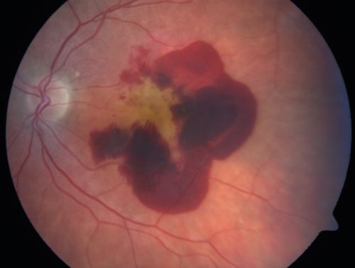 Wet AMD with haemorrhage from neovascularization
