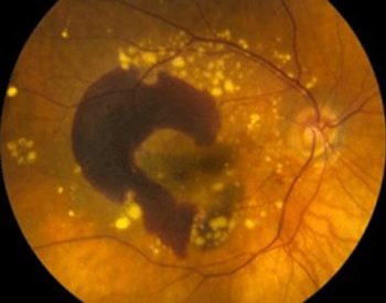 Retina image of wet AMD