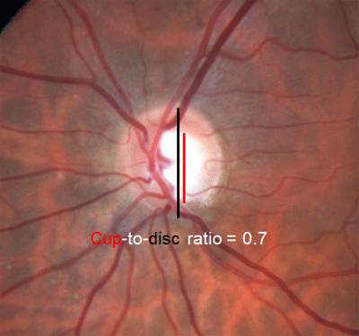 In glaucoma raised IOP damages nerve fibres. As they die away the neuro retinal rim gets thinner and therefore the cup gets larger.