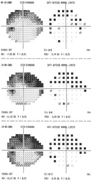 The black areas show the parts of the visual field not seen during automated visual field testing. Note the central area (centre of crosshairs) is still preserved, despite extensive loss of peripheral vision. Over time (top to bottom) the visual field defect increases.