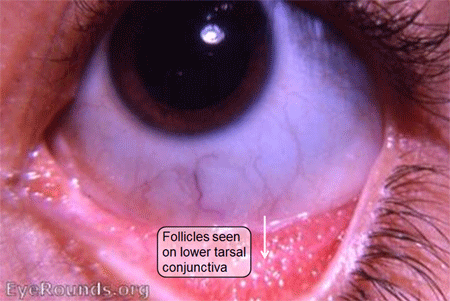 Follicular conjunctivitis: Follicles seen on lower tarsal conjunctiva
