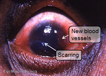 Trachoma with corneal scarring and neovascularisation