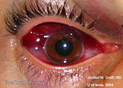 Subconjunctival haemorrhage following eye trauma.