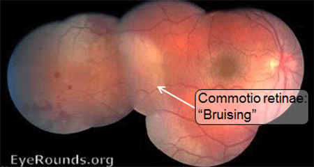 commotio-retinae