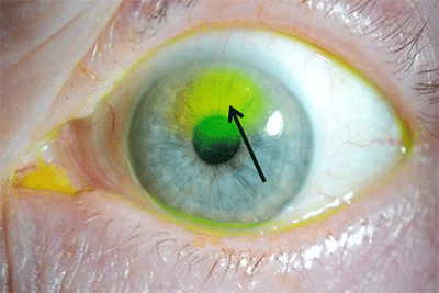 Corneal abrasion