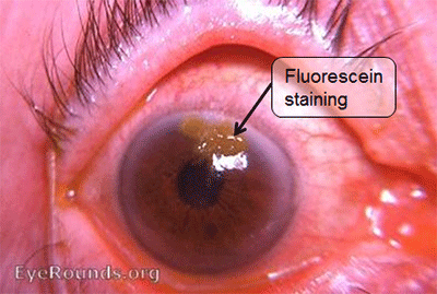 fluorescein-staining