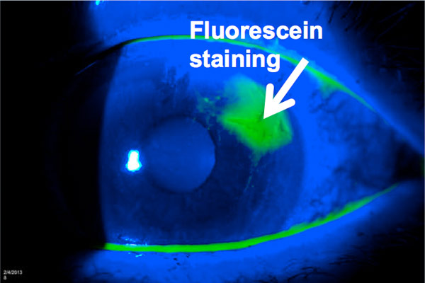 fluoroscein_staining