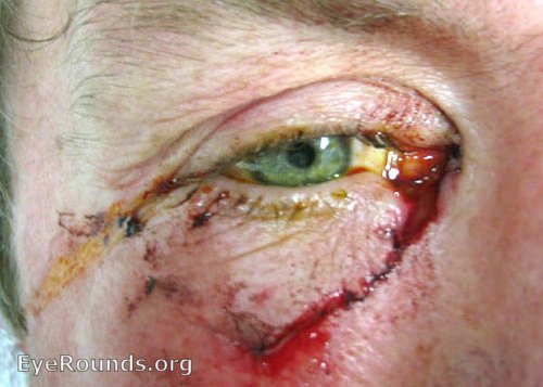 Eyelid laceration involving lid margin and canaliculus
