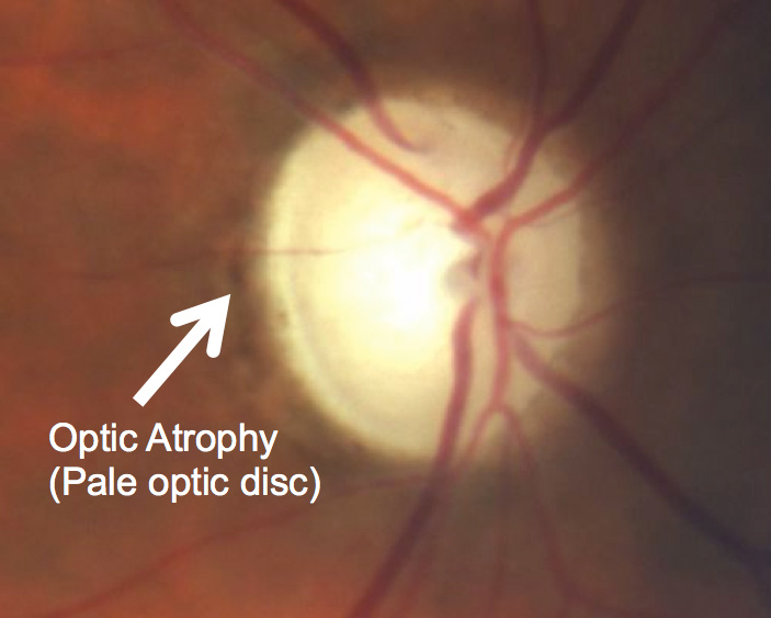optic-atrophy-2