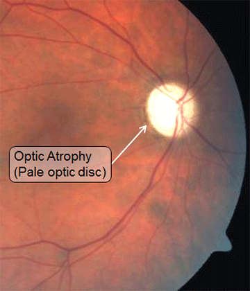 optic-atrophy