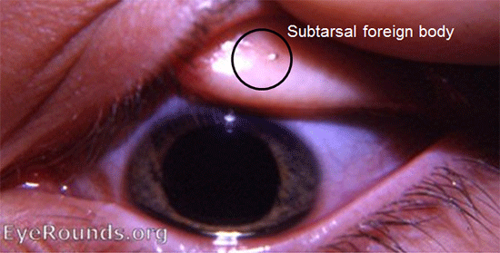 subtarsal foreign body