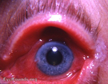 viral conjunctivitis