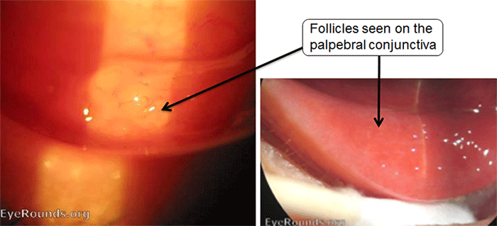 Follicles seen on the palpebral conjuntiva