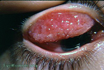 allergic conjunctivitis