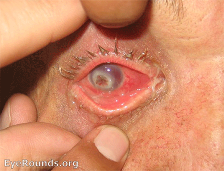 perforated corneal ulcer