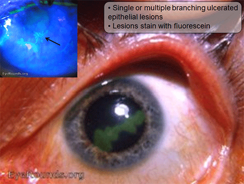 bacterial keratitis