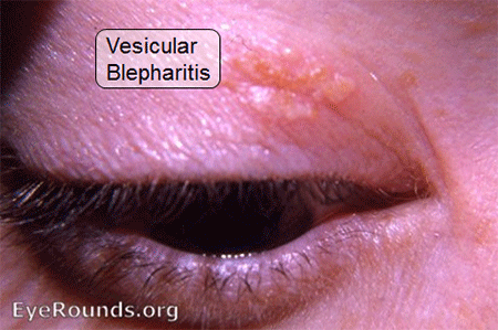 vesicular blephritis