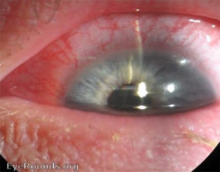 anterior-uveitis