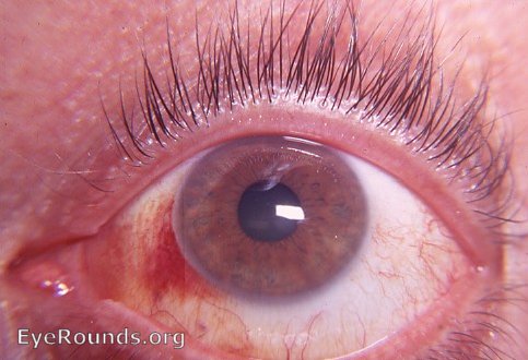 subconjunctival hemorrhage