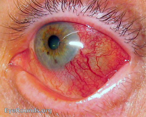 photo of an eye with scleritis