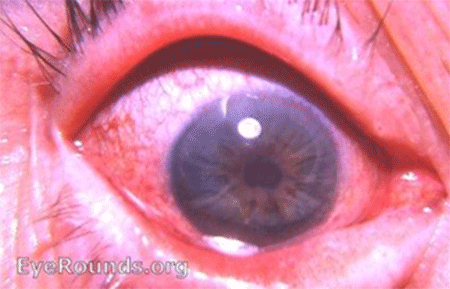 aac-glaucoma