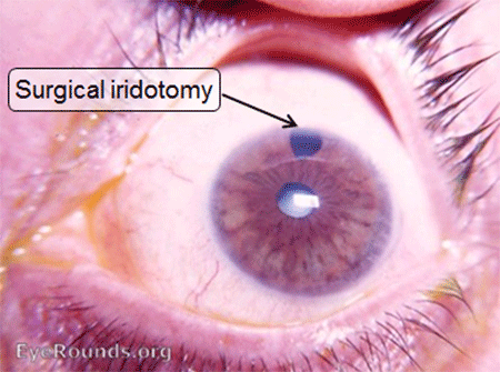 surgical iridotomy