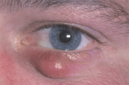 chalazion