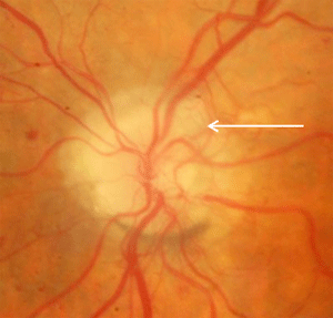 New vessels at the disc (NVD's) occur in proliferative diabetic retinopathy in response to vascular endothelial growth factors, released in response to retinal ischemia.