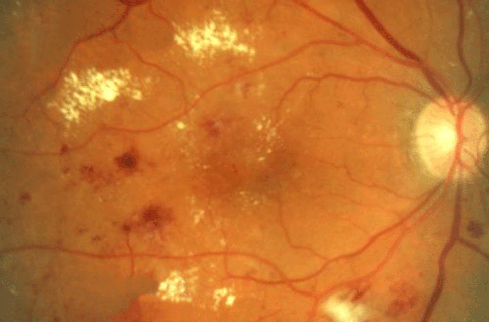 Diabetic Retinopathy