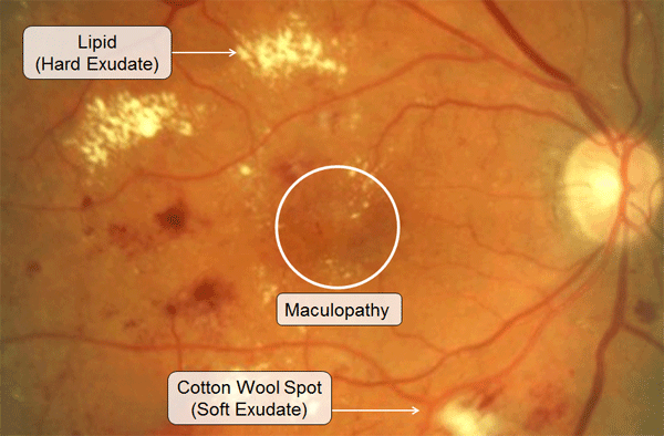 Diabetic retinopathy