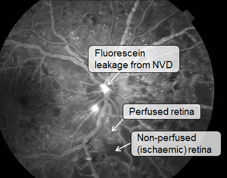 Fluorescein angiogram of the same eye