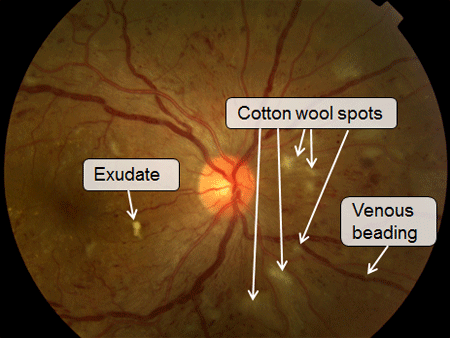 Fundus photograph of diabetic retinopathy