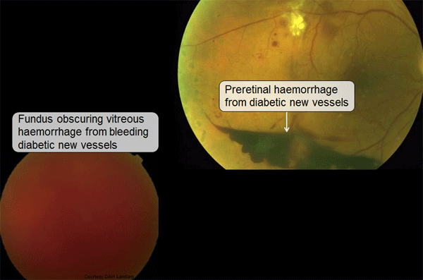 Vitreous Haemorrhage