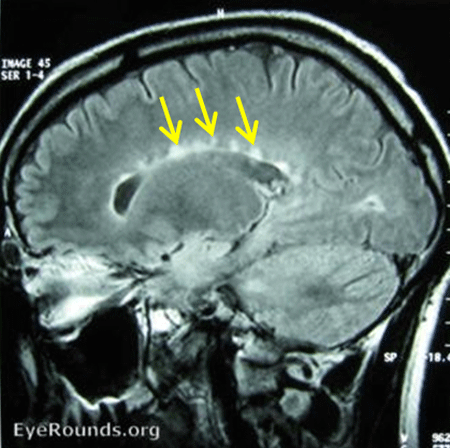 Multiple periventricular white matter lesions on MRI