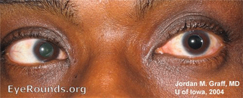 6th (abducens) cranial nerve palsy affecting left lateral rectus muscle, with failure to abduct left eye on left gaze.
