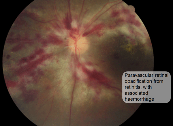 Paravascular retinal opacification from retinitis, with associated haemorrhage