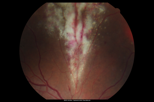 Acute CMV retinitis