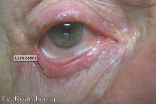 Blepharitis - Sticky debris at root of lashes
