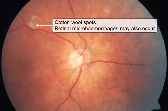Cotton wool spots - Retinal microhaemorrhages may also occur