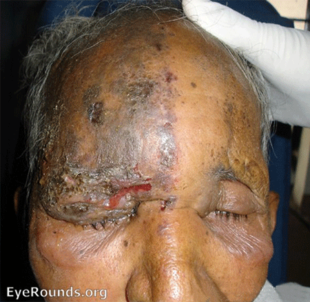 Herpes Zoster Ophthalmicus. Note Trigeminal (V1) distribution.