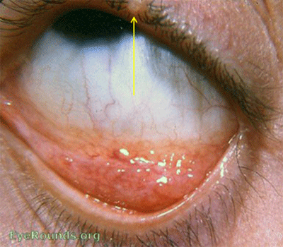 Small nodule on eyelid or lid margin