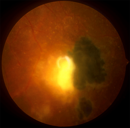 Active toxoplasma retinitis – the hyperpigmented area shows old disease, that has reactivated produce white appearing retinitis
