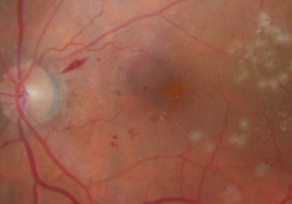 Diabetic retinopathy