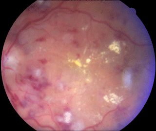 Hypertensive retinopathy