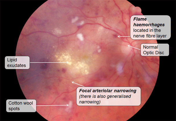 Signs of hypertensive retinopathy
