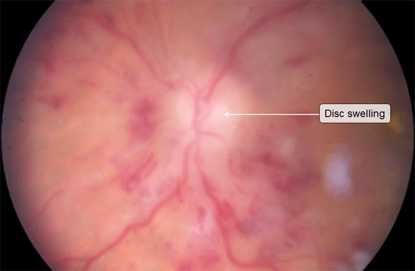 Disc swelling in hypertensive retinopathy