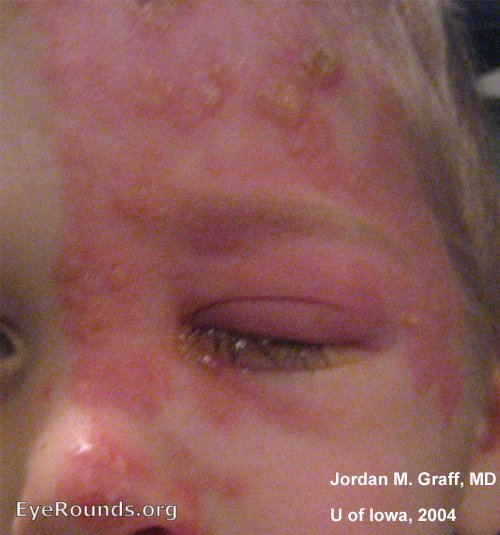 Child with Herpes Zoster