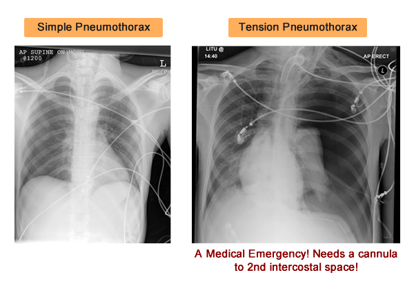 Pneumothorax