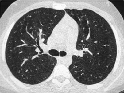 chest ct