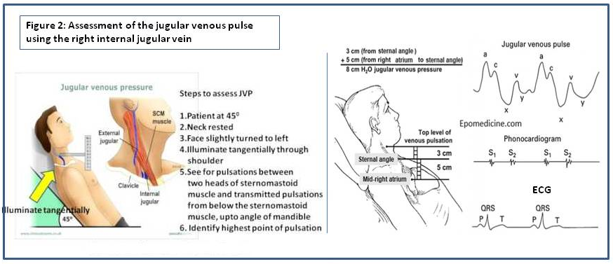 Checking jugular venous pulse